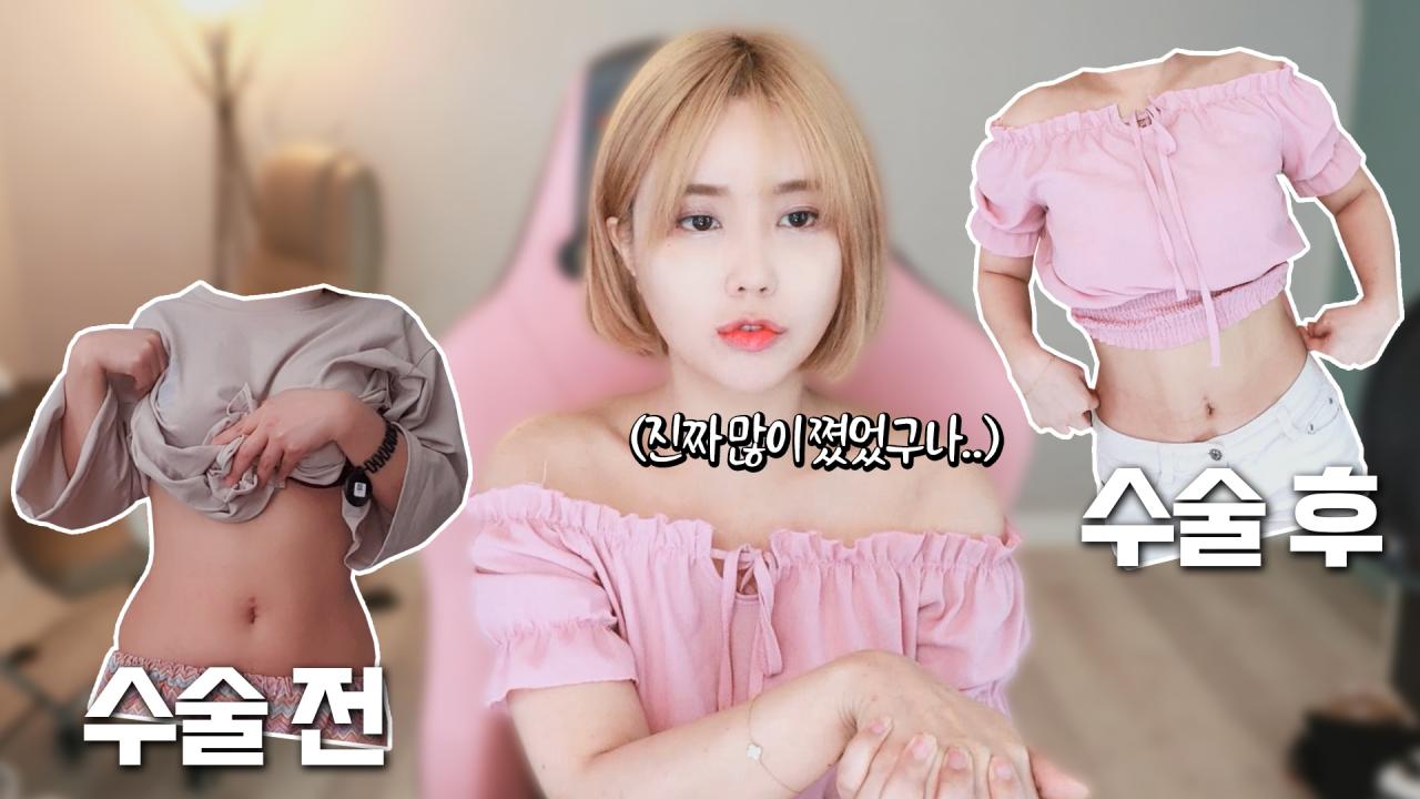 드디어 지방 흡입을 했어요!! 수술 상담부터 ~ 수술 후 7일간의 리얼후기!